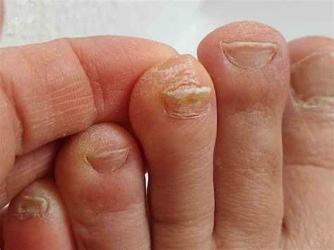 the thickness of an toenail uses what unit of measurement|how to reduce toenail thickness.